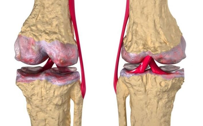 Osteoartróza kolenného kĺbu