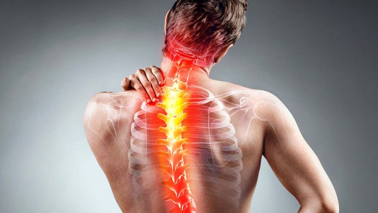 príznaky osteochondrózy chrbtice